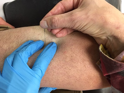 Dry Needling and Acupuncture Penticton